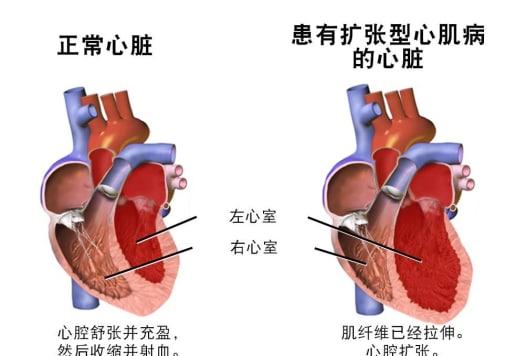 擴(kuò)張性心肌病嚴(yán)重嗎