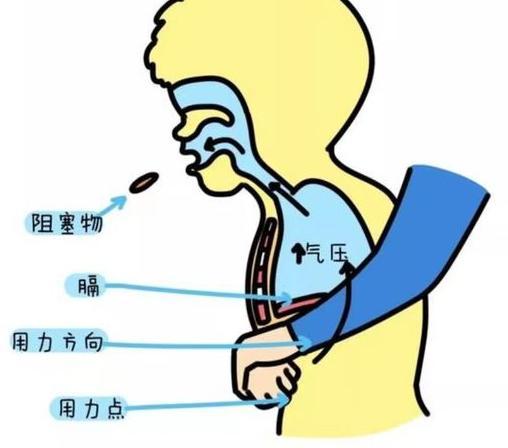 食物卡住喉嚨的急救方法