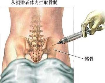 骨髓移植后需要注意什么？