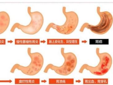 胃潰瘍出血飲食要注意些什么呢？